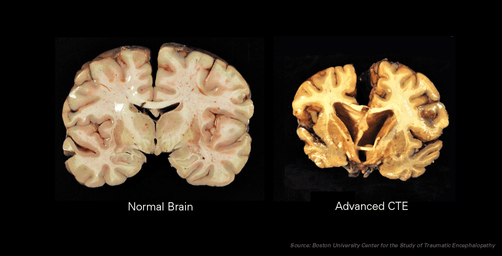 New Medical Study Connecting CTE to Sports Concussion