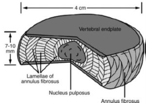 Illustration of vertebral endplate back pain